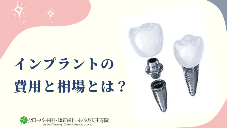 インプラントの費用と相場とは?