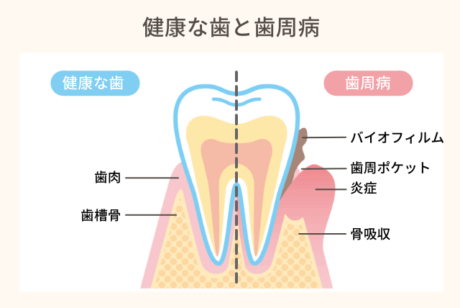 健康な歯と歯周病