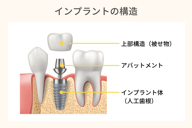 インプラントの構造