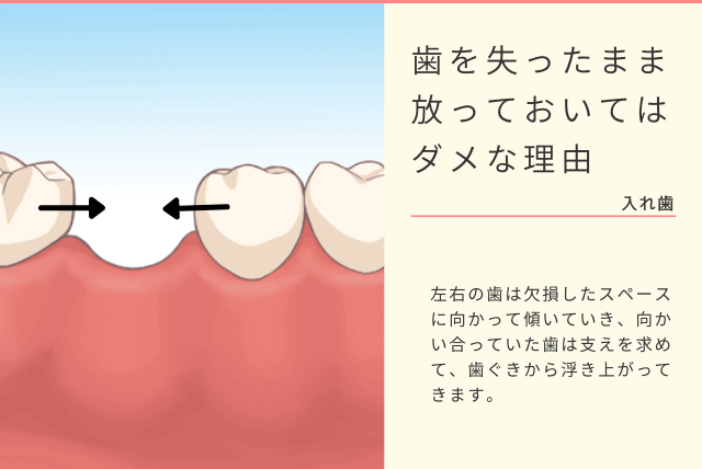 歯を失ったまま放っておいてはダメな理由