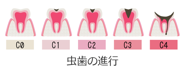 虫歯の進行