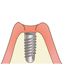 インプラント埋入手術後
