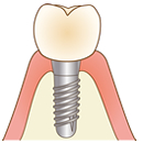 インプラント治療
