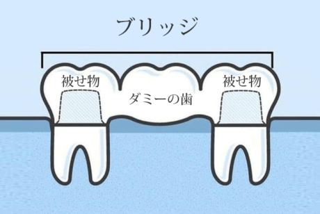 ブリッジの図解