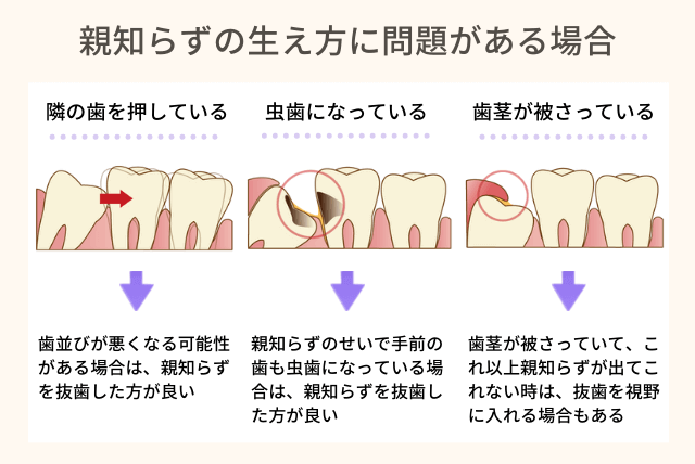 親知らずの生え方に問題がある場合