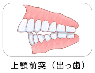 上顎前突（出っ歯）