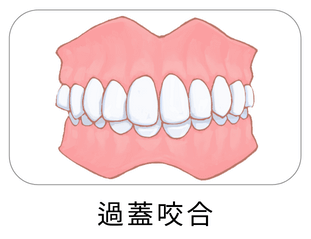 過蓋咬合