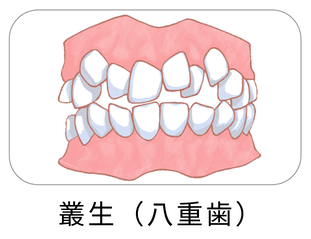 叢生（八重歯）