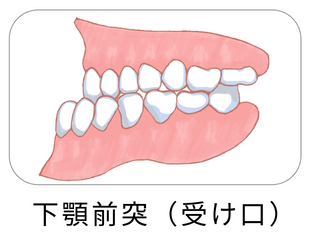 下顎前突（受け口）