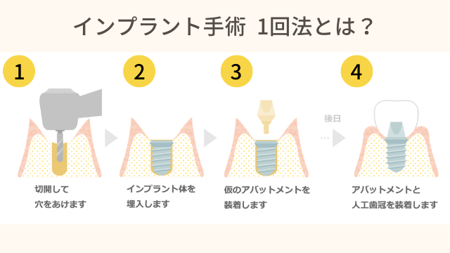 インプラント手術1回法