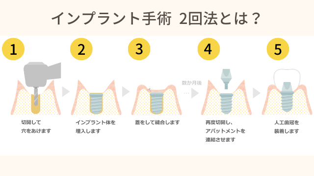 インプラント手術2回法