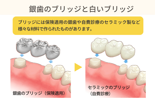 銀歯のブリッジと白いブリッジ