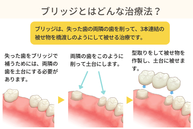 ブリッジとはどんな治療法？