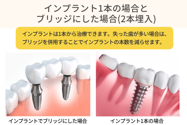 インプラント1本の場合とブリッジにした場合