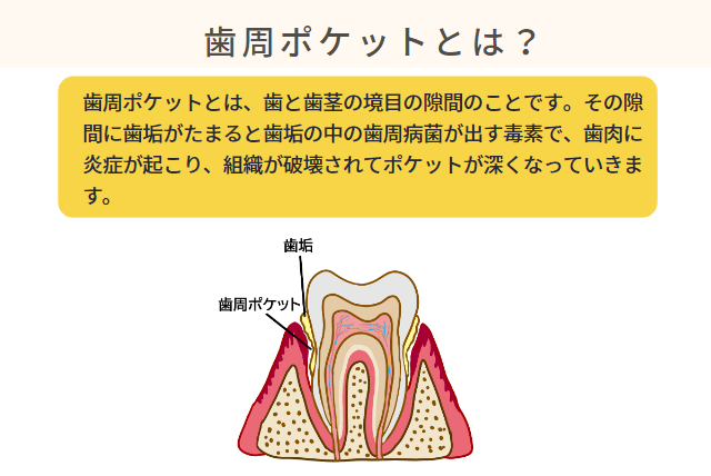 歯周ポケットとは？