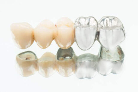 銀歯とセラミック