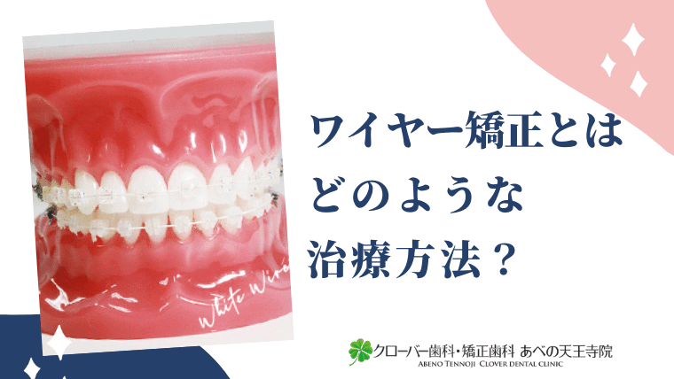 ワイヤー矯正とはどのような治療方法？