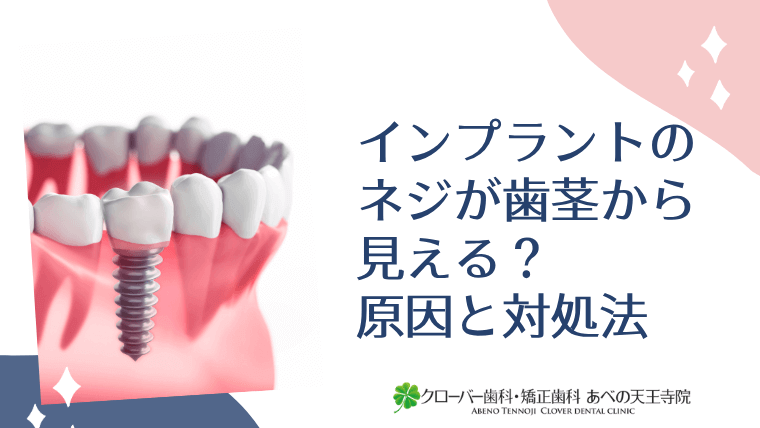 インプラントのネジが歯茎から見える?原因と対処法