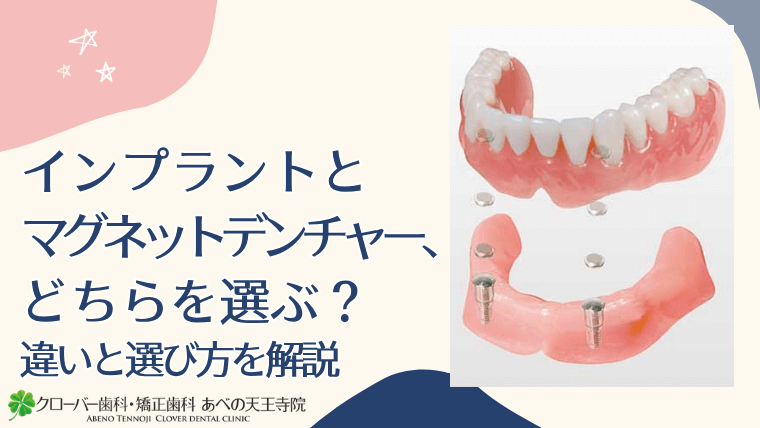 インプラントとマグネットデンチャー、どちらを選ぶ？