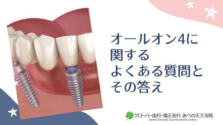オールオン4に関するよくある質問とその答え