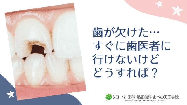 歯が欠けた…すぐに歯医者に行けないけどどうすれば？