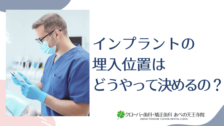 インプラントの埋入位置はどうやって決めるの?