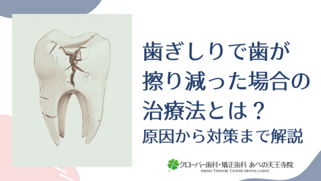 歯ぎしりで歯が擦り減った場合の治療法とは？