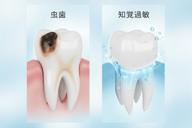 虫歯と知覚過敏の違い