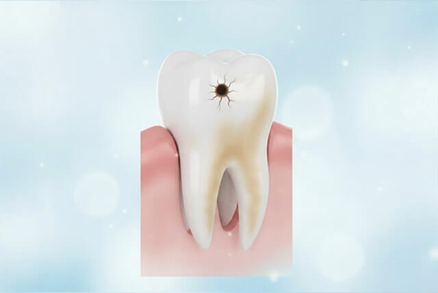 虫歯