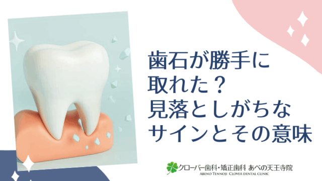 歯石が勝手に取れた？見落としがちなサインとその意味