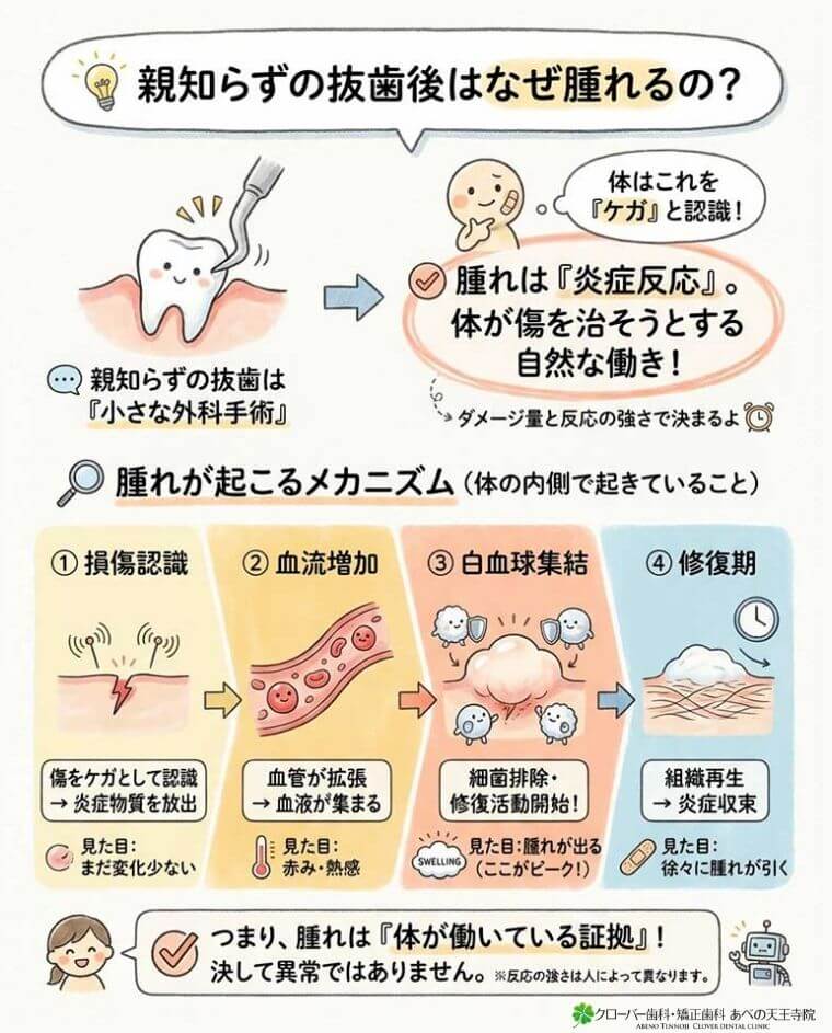 親知らずの抜歯後はなぜ腫れるの？