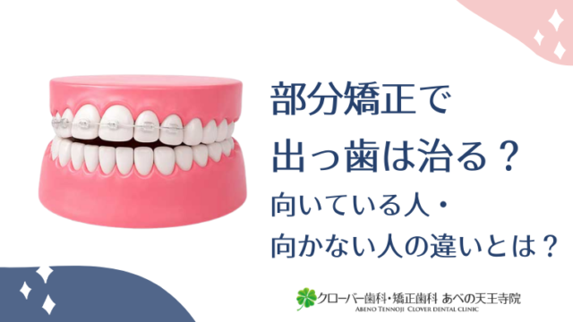 部分矯正で出っ歯は治る？向いている人・向かない人の違いとは