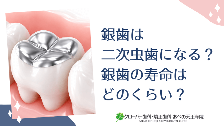 銀歯は二次虫歯になる？銀歯の寿命はどのくらい？