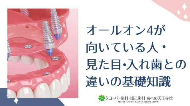 オールオン4が向いている人・見た目・入れ歯との違いの基礎知識