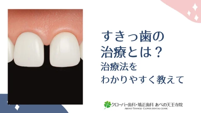すきっ歯の治療とは？治療法をわかりやすく教えて