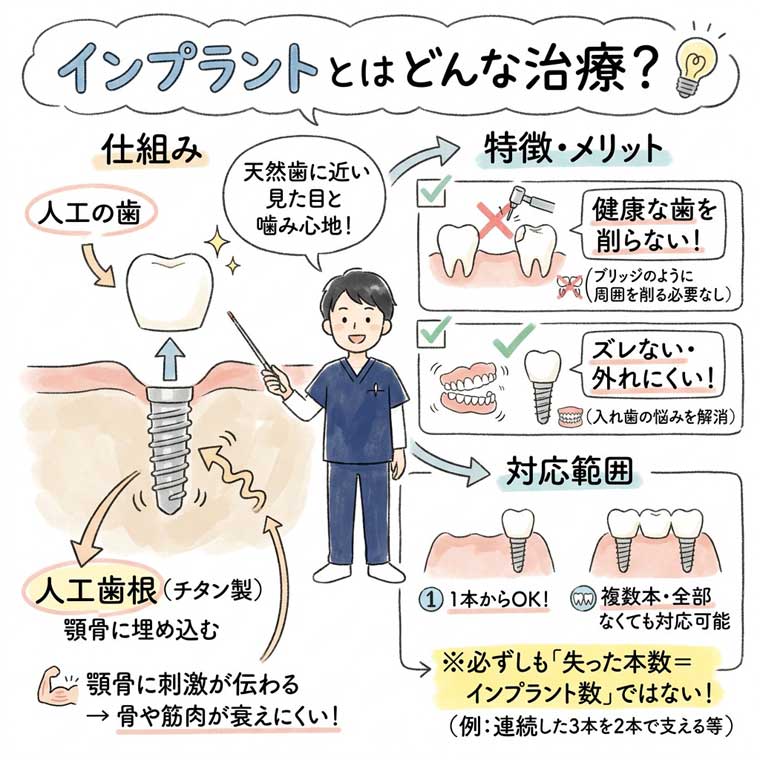 インプラントとはどんな治療？の図解