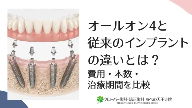 オールオン4と従来のインプラントの違いとは？費用・本数・治療期間を比較
