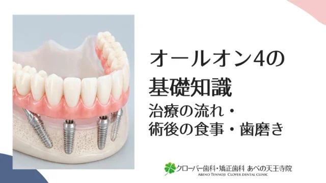 オールオン4の基礎知識｜治療の流れ・術後の食事・歯磨き
