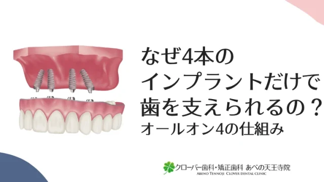 なぜ4本のインプラントだけで歯を支えられるの？オールオン4の仕組み