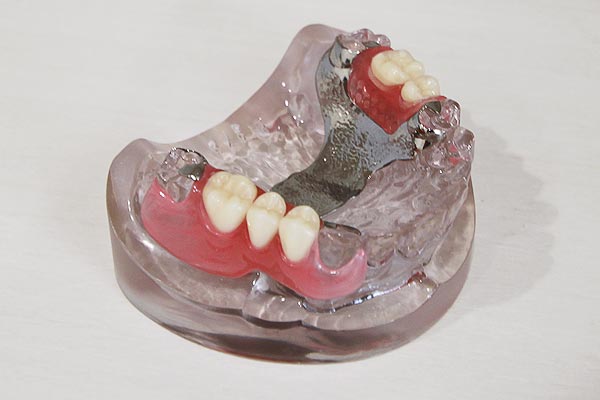 入れ歯(義歯)治療