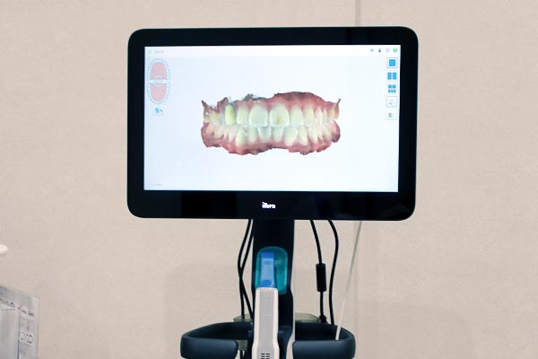 iTero5Dによる虫歯検知