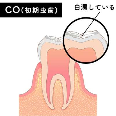 CO（初期虫歯）